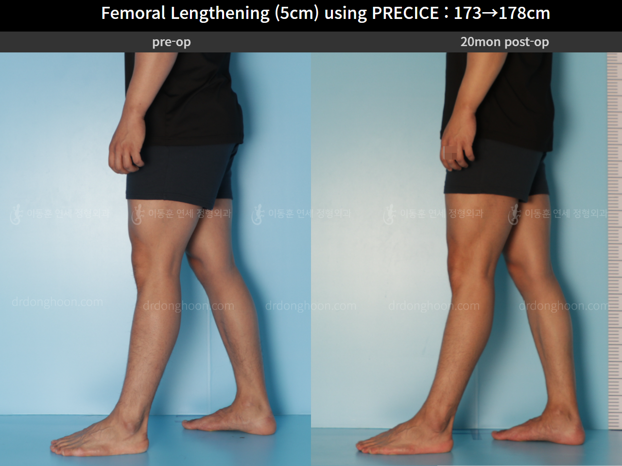 Before and after cll precice, case 4573533, image 8, Dr. Donghoon institute (DALRI)