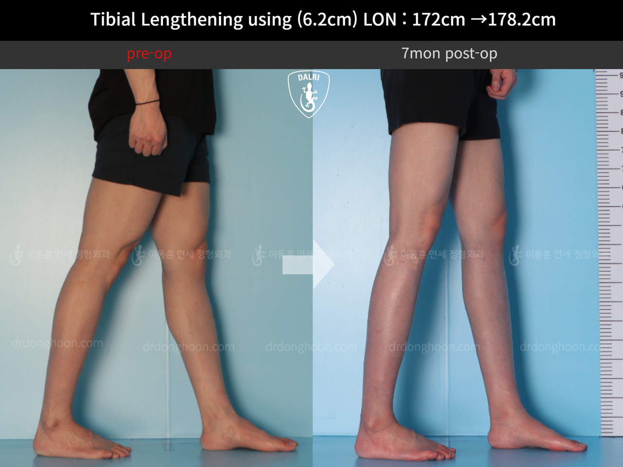 Before and after cll lon, case 12519142, image 8, Dr. Donghoon institute (DALRI)