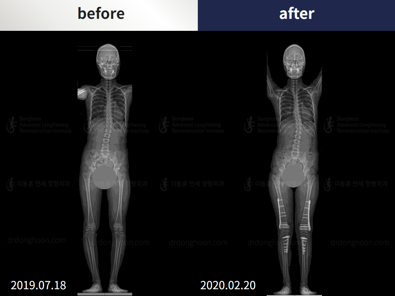 Before and after recurrent patella dislocation, case 4594124, image 2, Dr. Donghoon institute (DALRI)