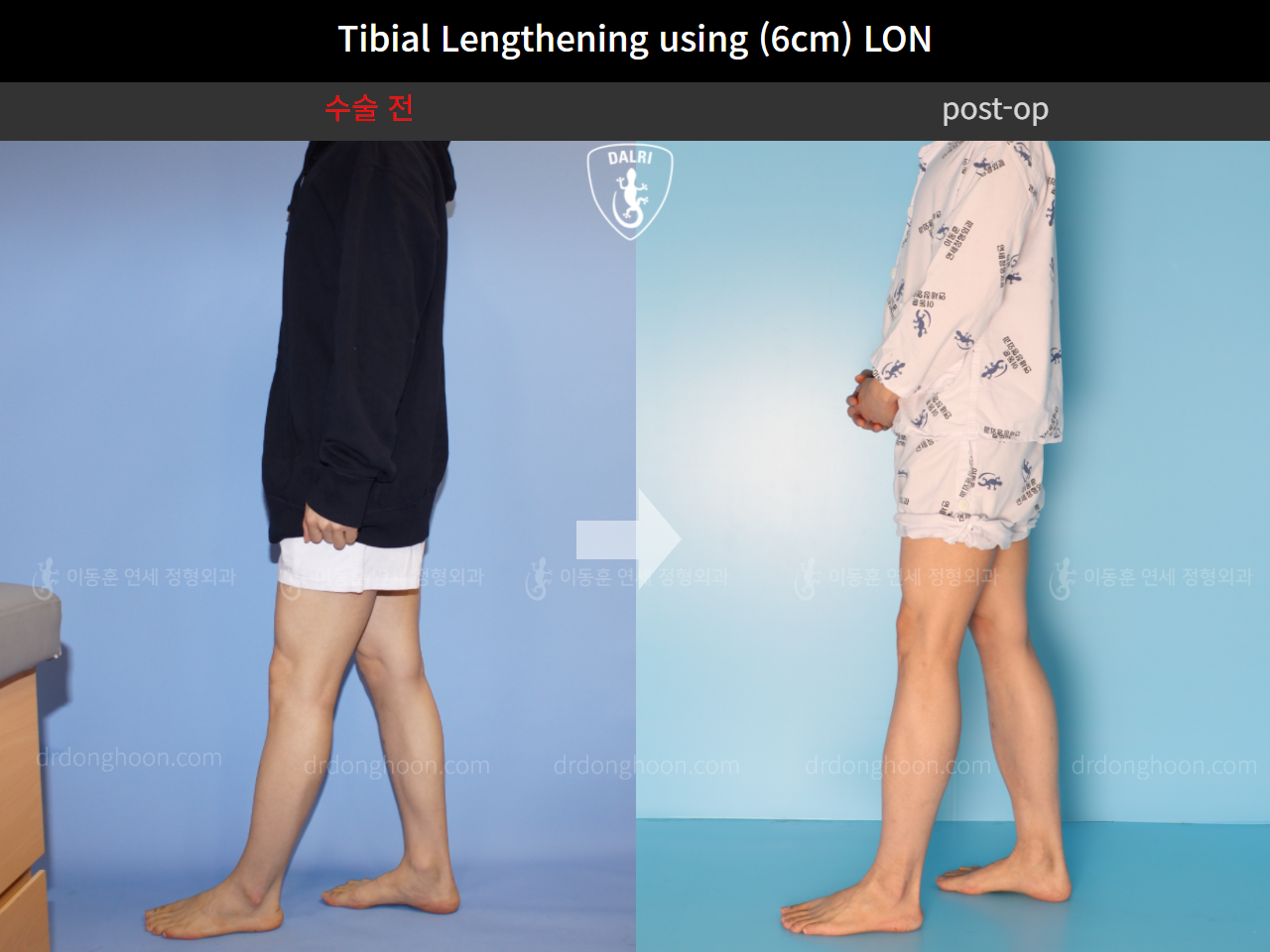 Before and after cll lon, case 4577694, image 4, Dr. Donghoon institute (DALRI)