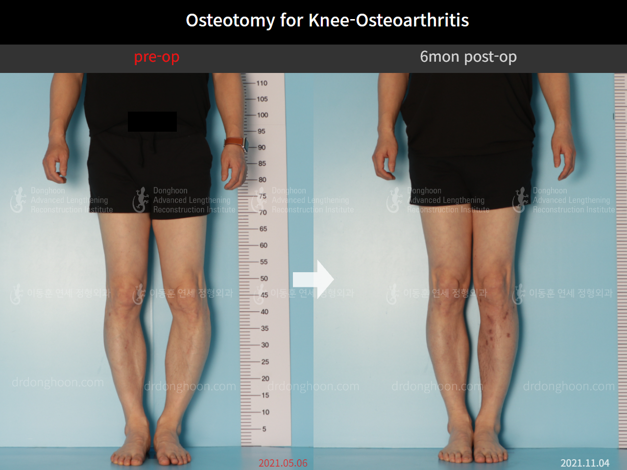 Before and after osteotomy for knee osteoarthritis, case 8796980, image 4, Dr. Donghoon institute (DALRI)