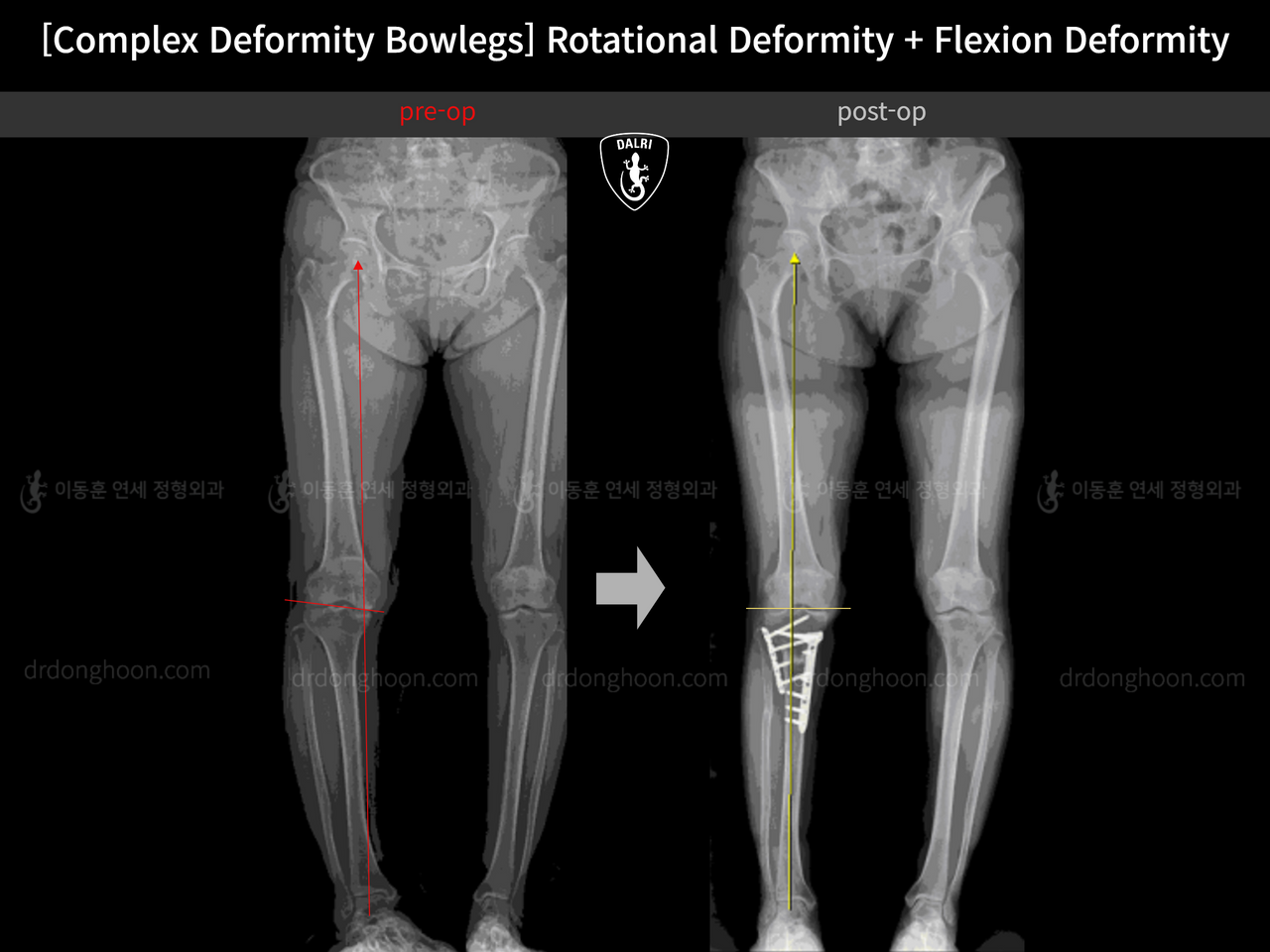Before and after flexion deformity, case 14362687, image 3, Dr. Donghoon institute (DALRI)