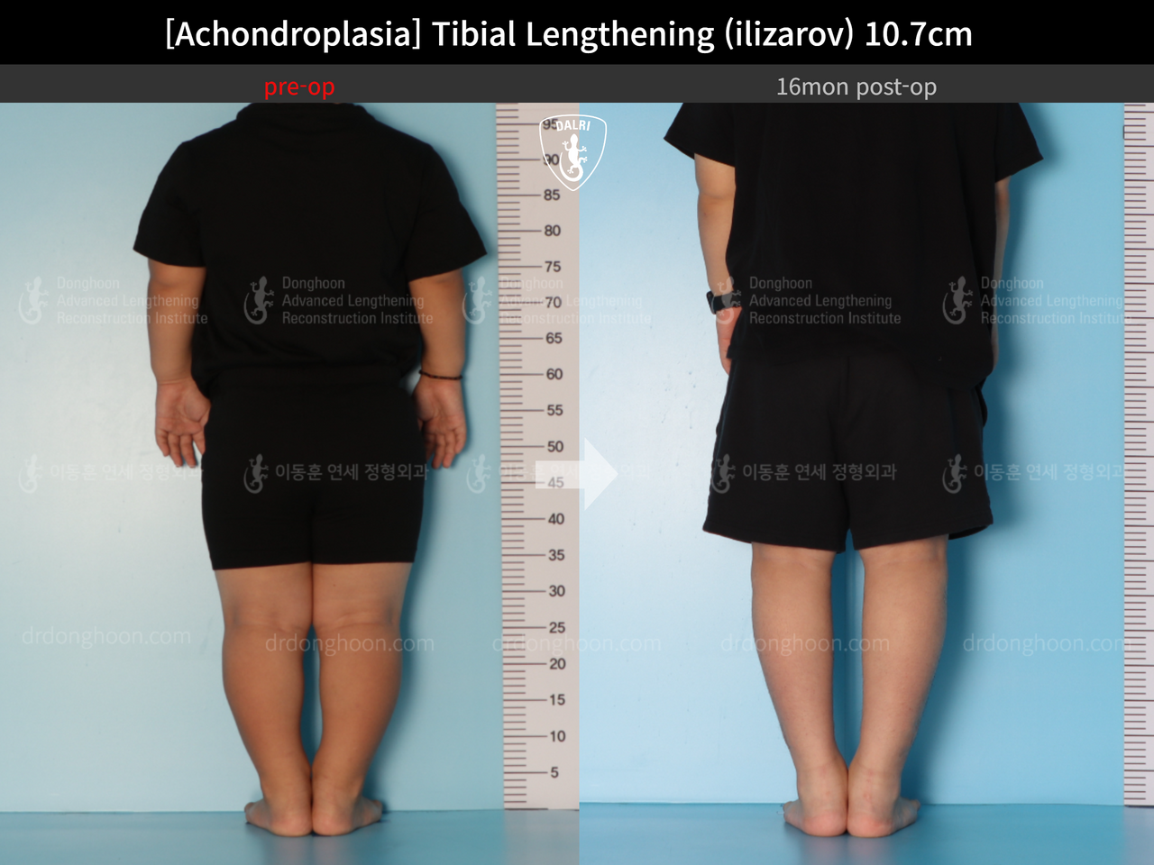 Before and after paediatric congenital condition, case 13489647, image 5, Dr. Donghoon institute (DALRI)