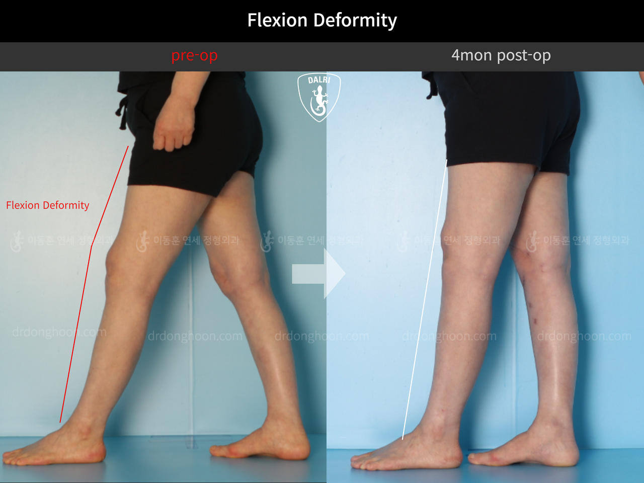 Before and after adult bowlegs, case 12586483, image 8, Dr. Donghoon institute (DALRI)