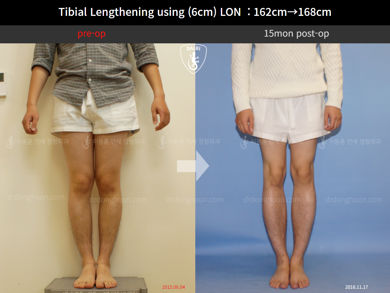 Before and after cll lon, case 4323473, image 1, Dr. Donghoon institute (DALRI)