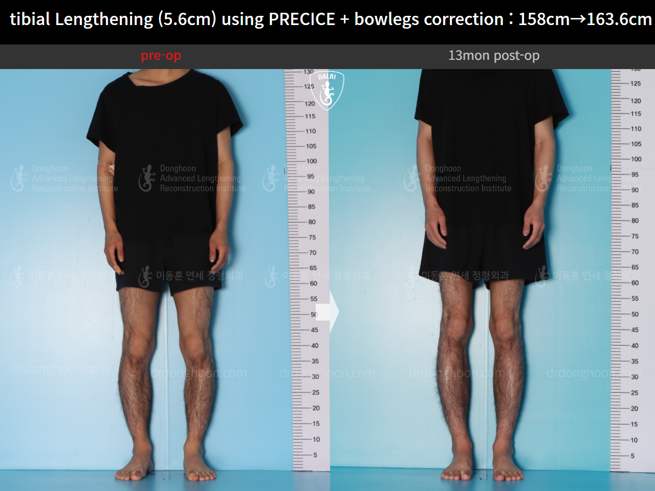 Before and after cll precice, case 16213622, image 2, Dr. Donghoon institute (DALRI)