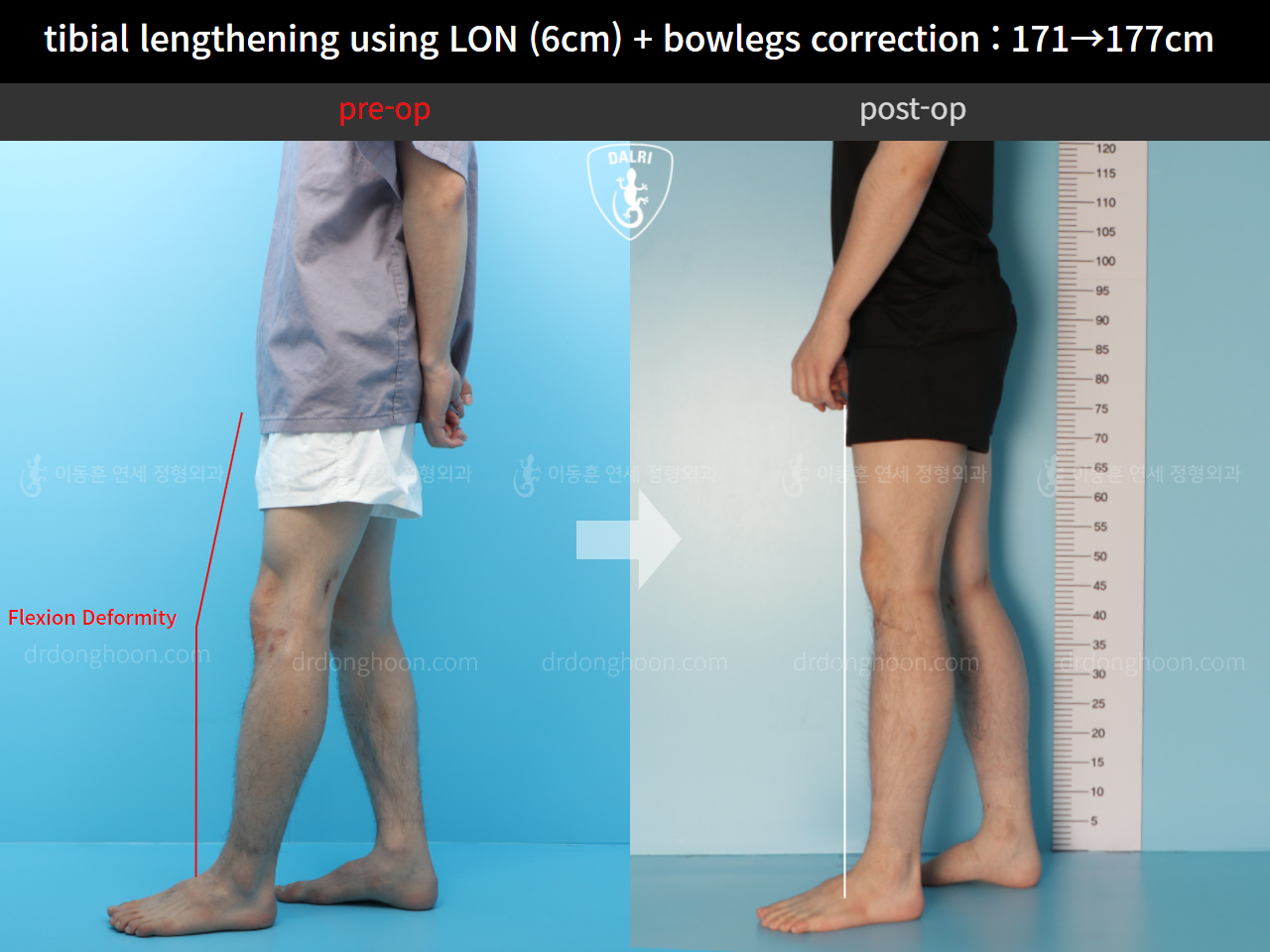 Before and after cll + deformity correction, case 11798378, image 5, Dr. Donghoon institute (DALRI)