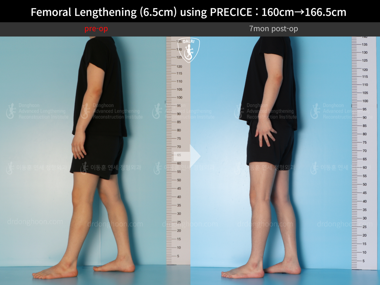 Before and after cll precice, case 13413485, image 3, Dr. Donghoon institute (DALRI)