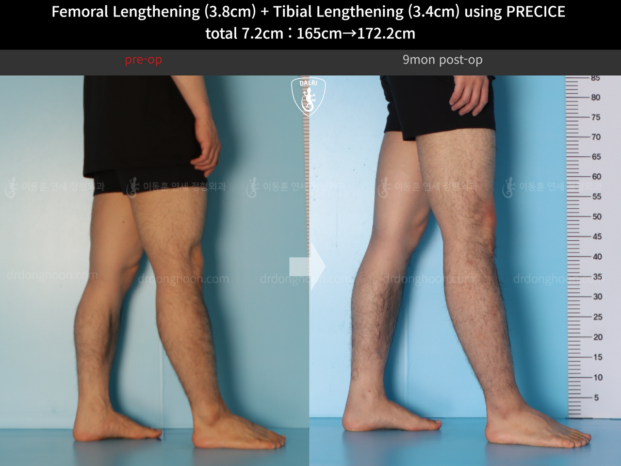 Before and after cll precice, case 14220657, image 9, Dr. Donghoon institute (DALRI)