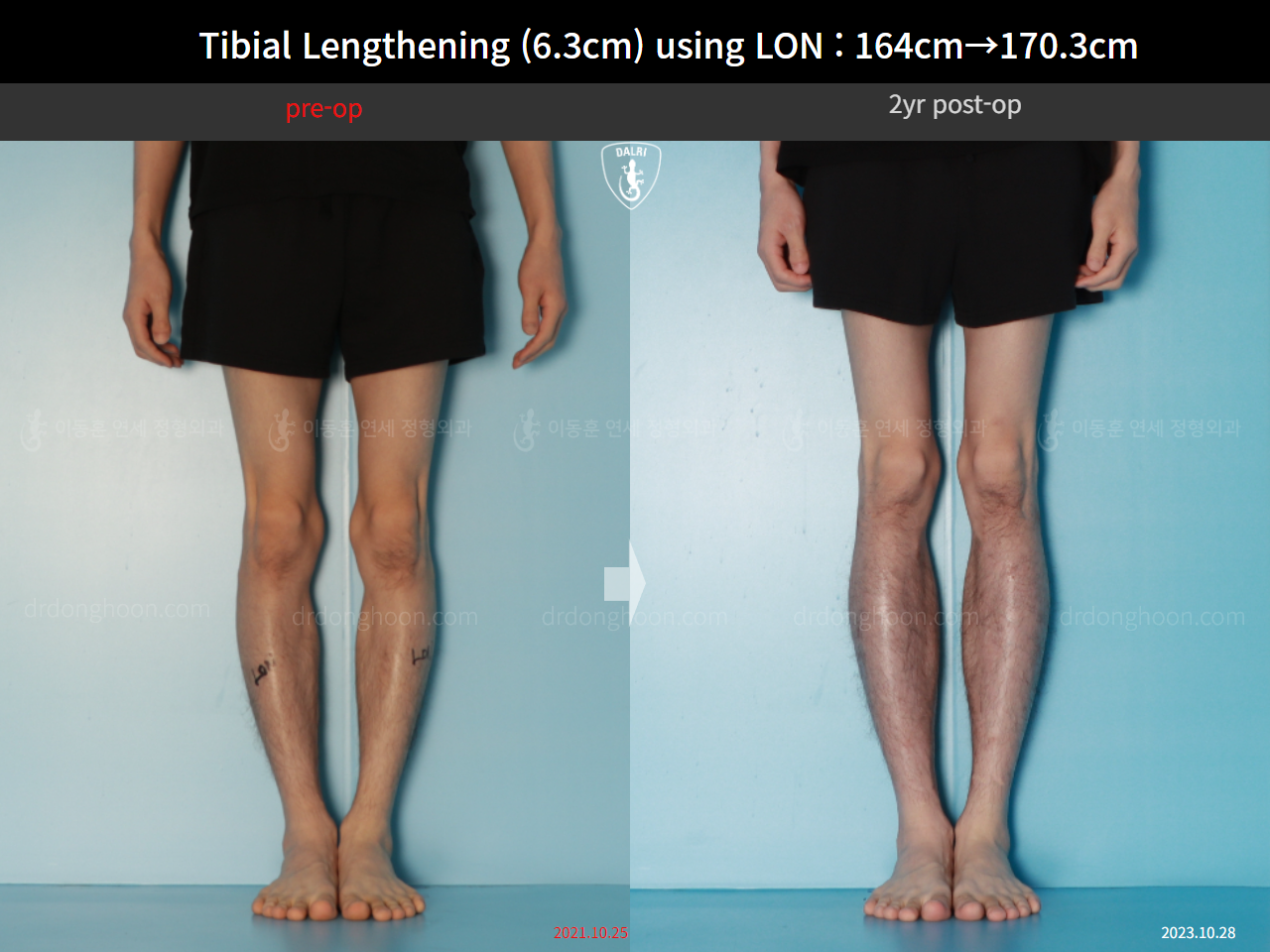 Before and after cll lon, case 16723608, image 9, Dr. Donghoon institute (DALRI)