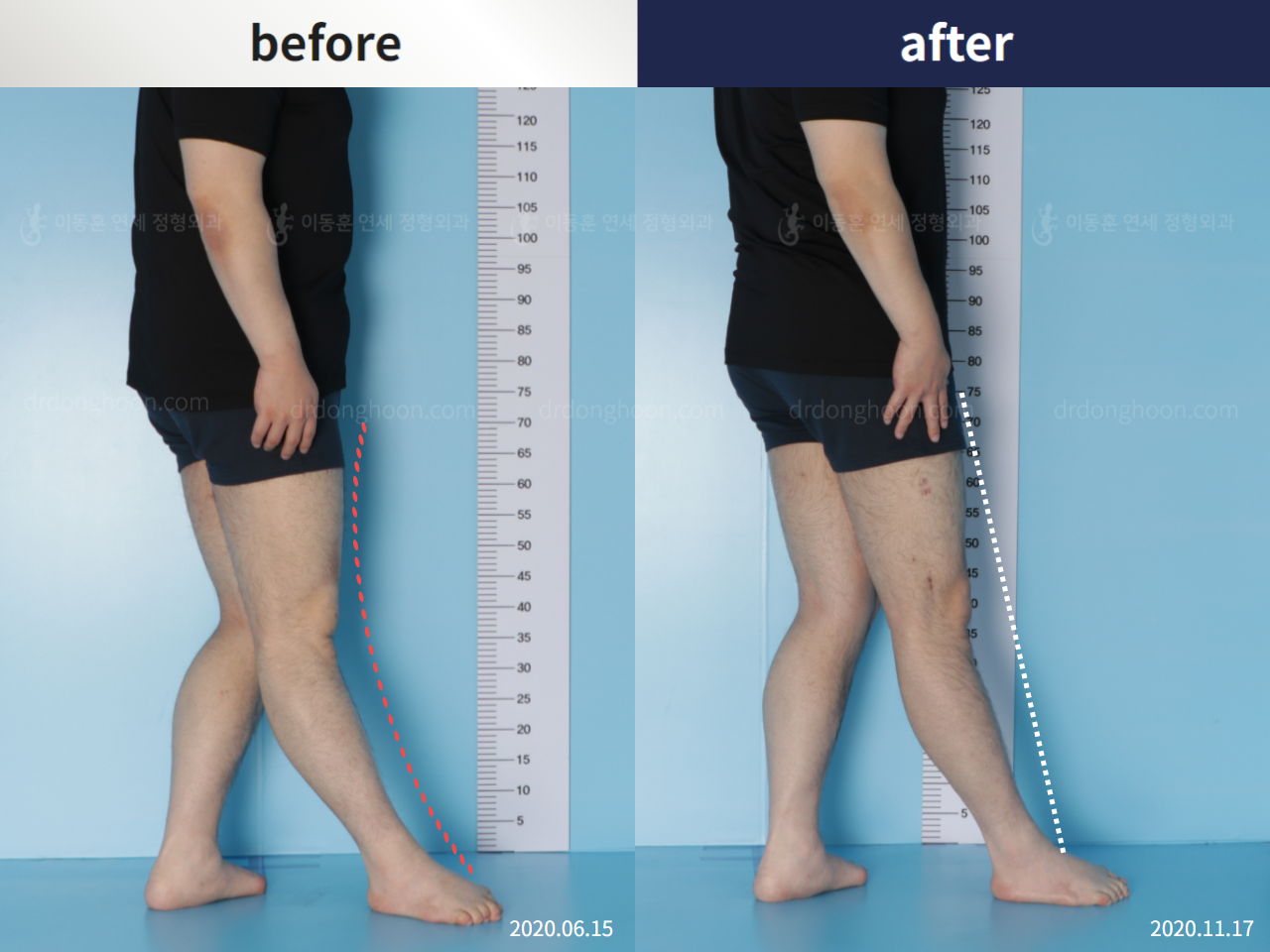 Before and after complex deformity, case 5346191, image 2, Dr. Donghoon institute (DALRI)