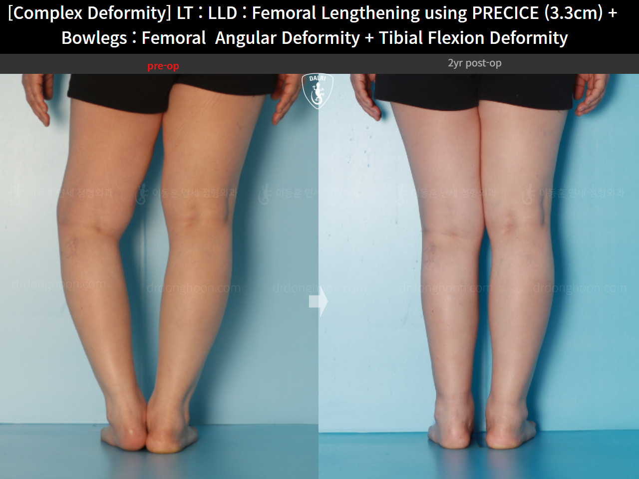 Before and after osteotomy for knee osteoarthritis, case 16786712, image 12, Dr. Donghoon institute (DALRI)
