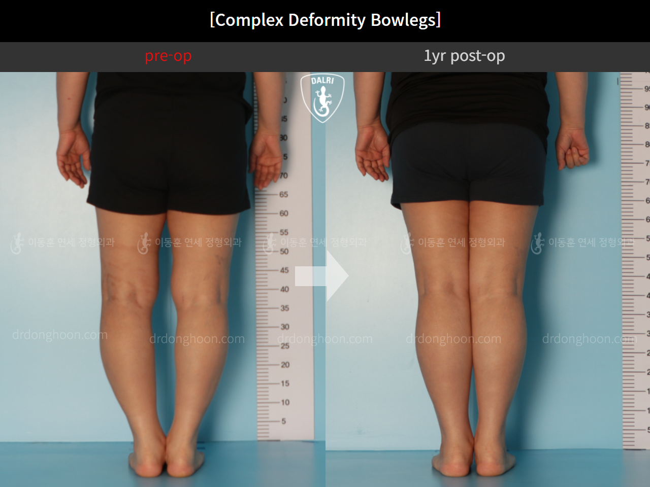 Before and after adult bowlegs, case 11339611, image 6, Dr. Donghoon institute (DALRI)