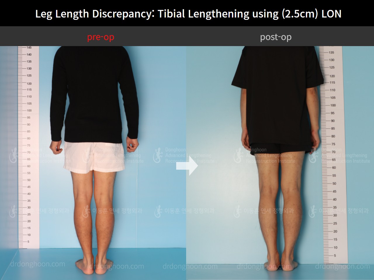 Before and after adult lld, case 8701735, image 3, Dr. Donghoon institute (DALRI)