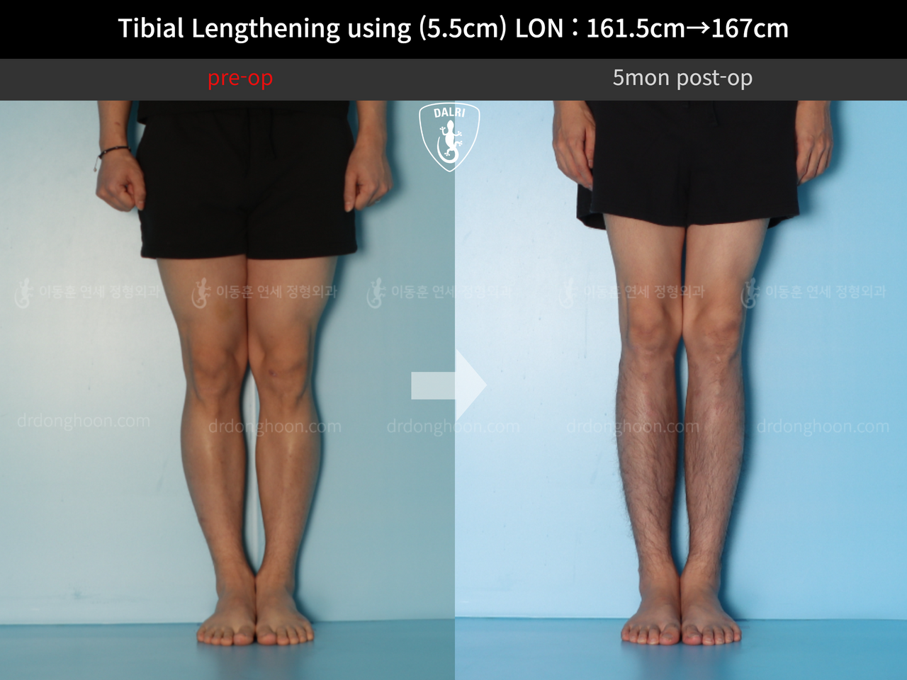 Before and after cll lon, case 12641751, image 5, Dr. Donghoon institute (DALRI)