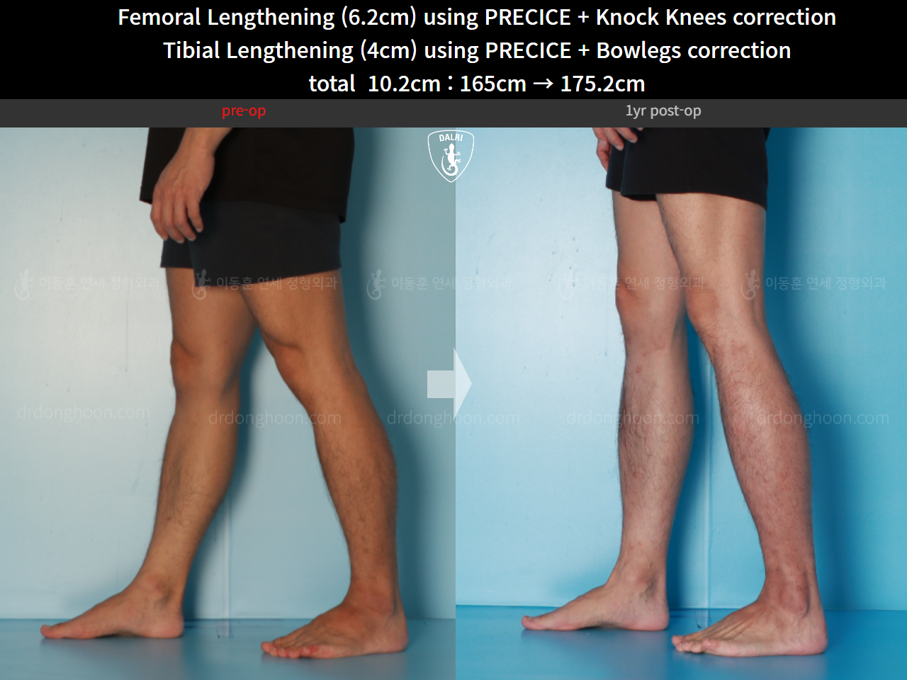 Before and after cll + deformity correction, case 15903252, image 11, Dr. Donghoon institute (DALRI)