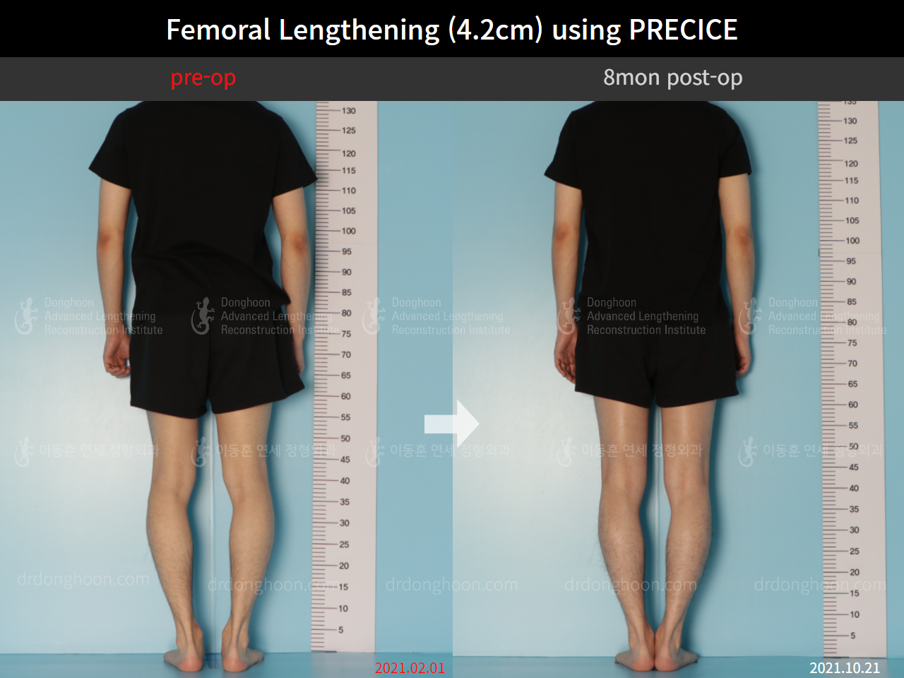 Before and after cll precice, case 8781700, image 2, Dr. Donghoon institute (DALRI)