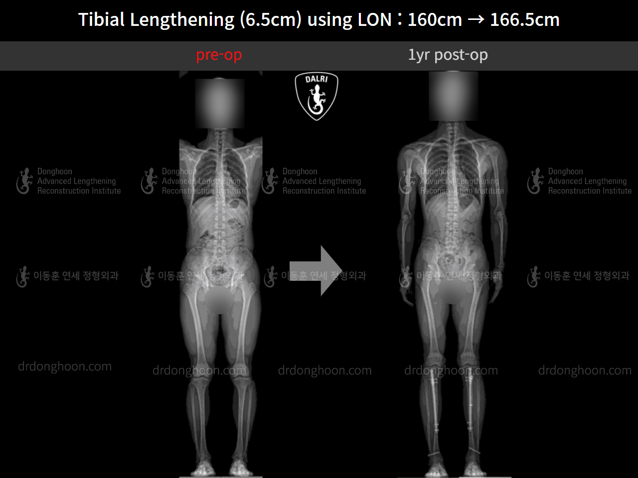 Before and after cll lon, case 10293105, image 9, Dr. Donghoon institute (DALRI)