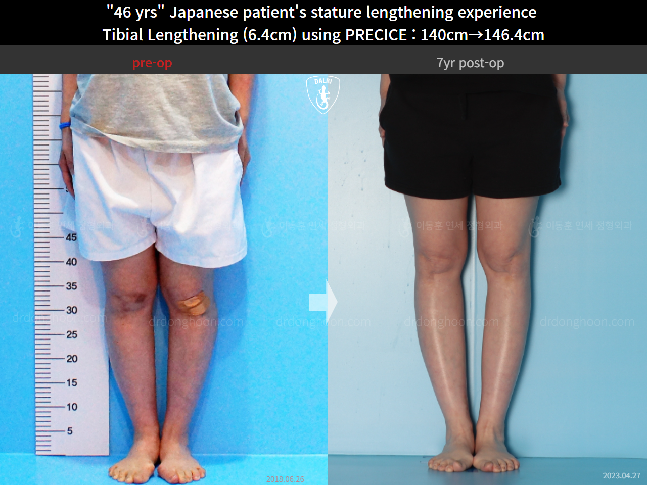 Before and after cll precice, case 4573580, image 7, Dr. Donghoon institute (DALRI)