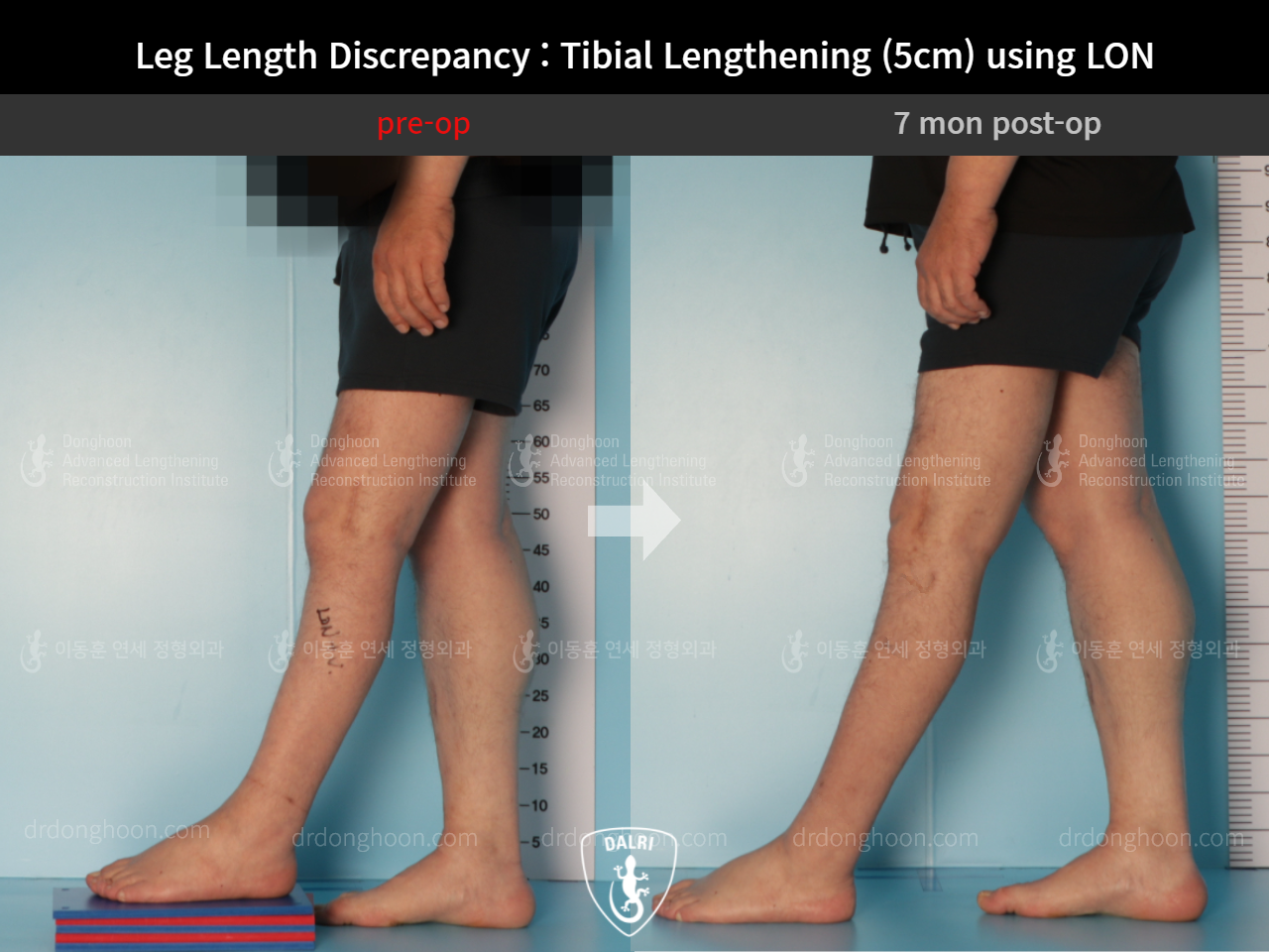 Before and after adult lld, case 9165807, image 7, Dr. Donghoon institute (DALRI)