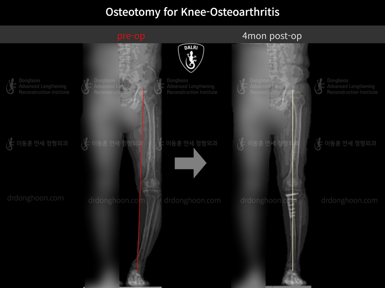 Before and after osteotomy for knee osteoarthritis, case 12535590, image 7, Dr. Donghoon institute (DALRI)