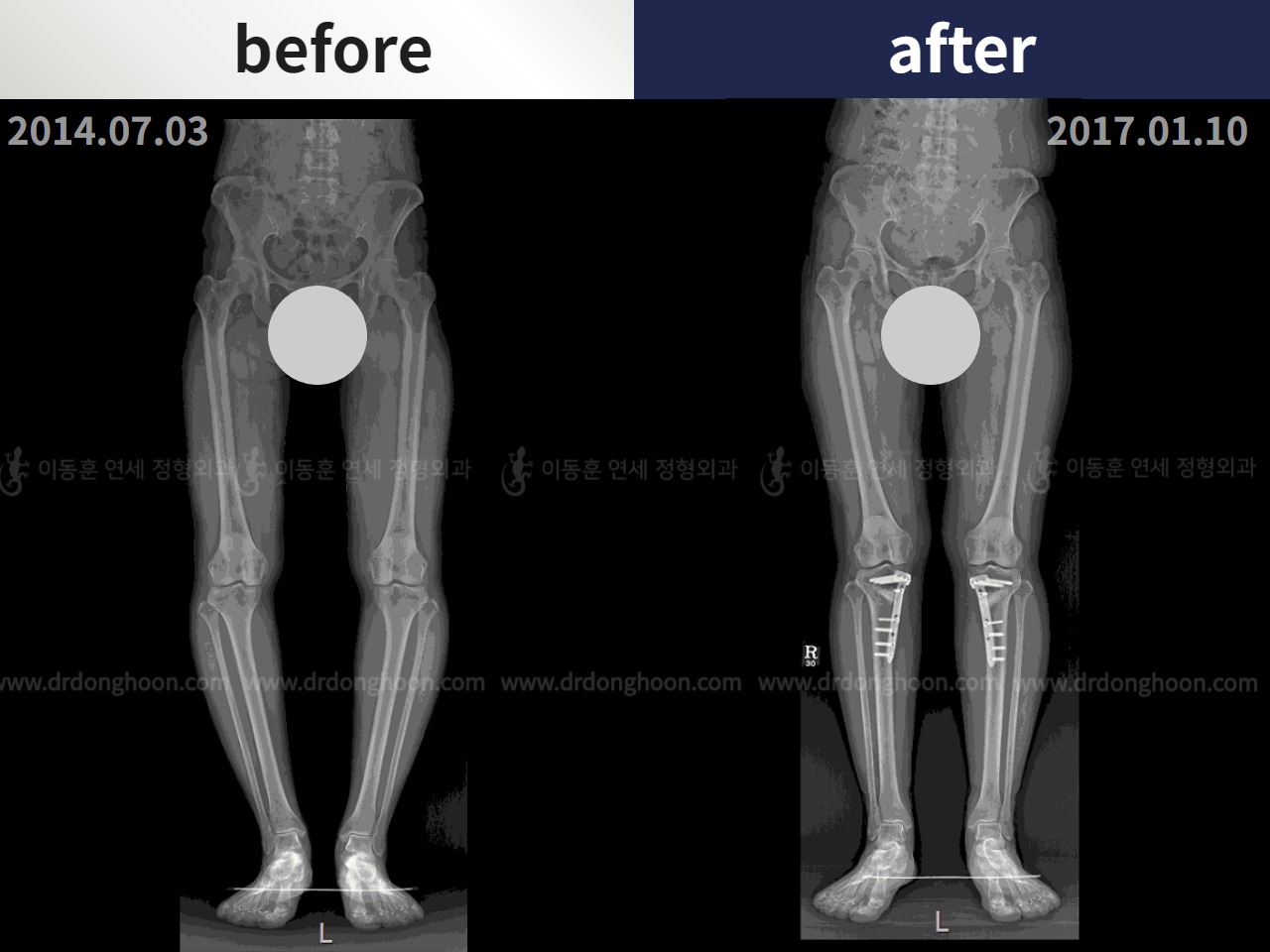 Before and after adult bowlegs, case 4311002, image 3, Dr. Donghoon institute (DALRI)