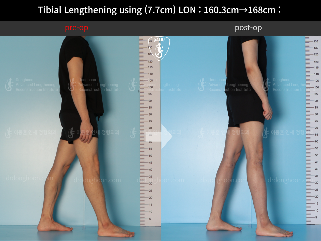 Before and after cll lon, case 12643440, image 3, Dr. Donghoon institute (DALRI)