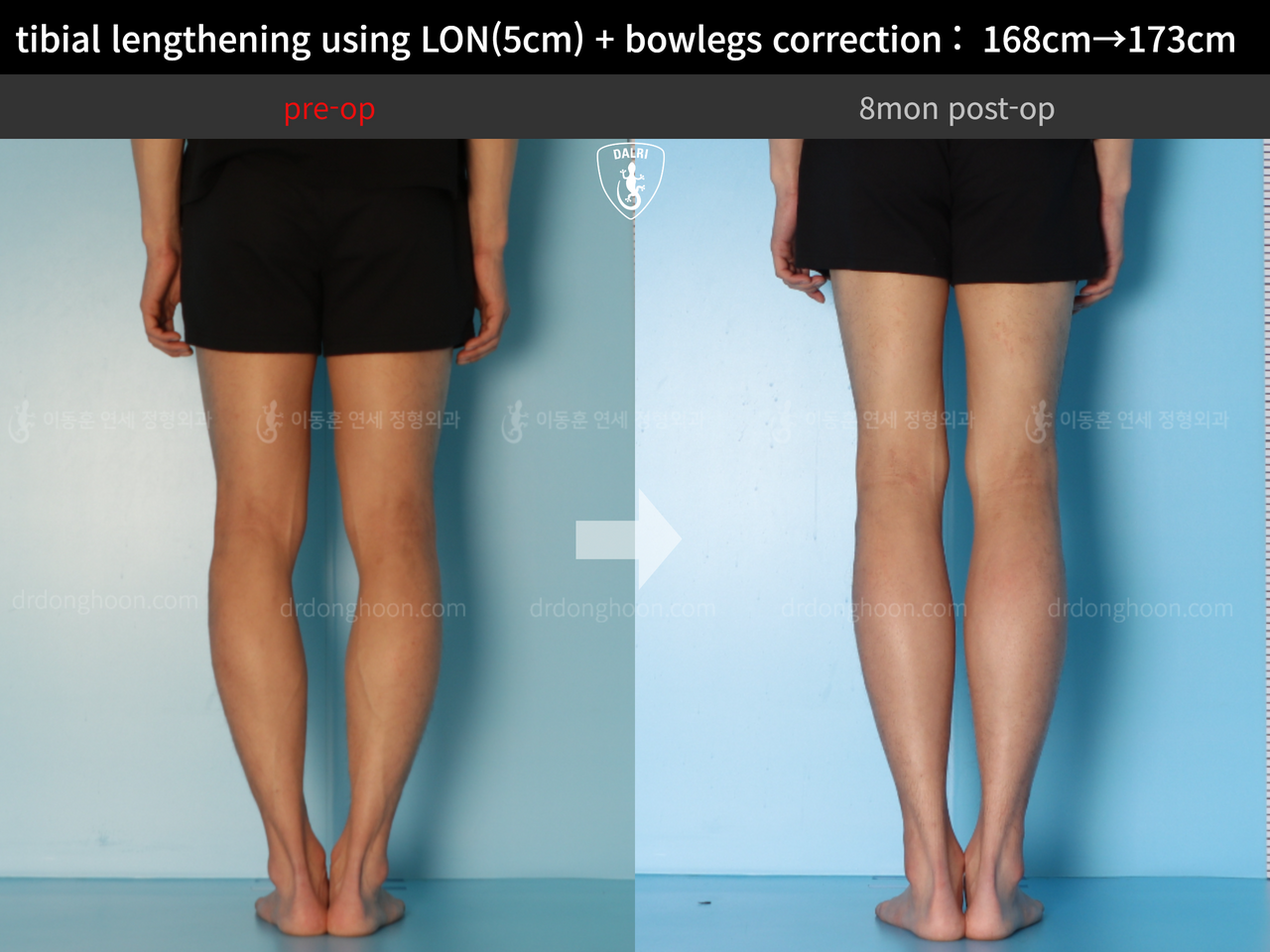 Before and after cll + deformity correction, case 13661181, image 8, Dr. Donghoon institute (DALRI)