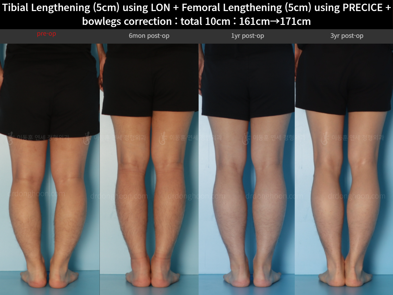Before and after cll precice, case 22208321, image 8, Dr. Donghoon institute (DALRI)