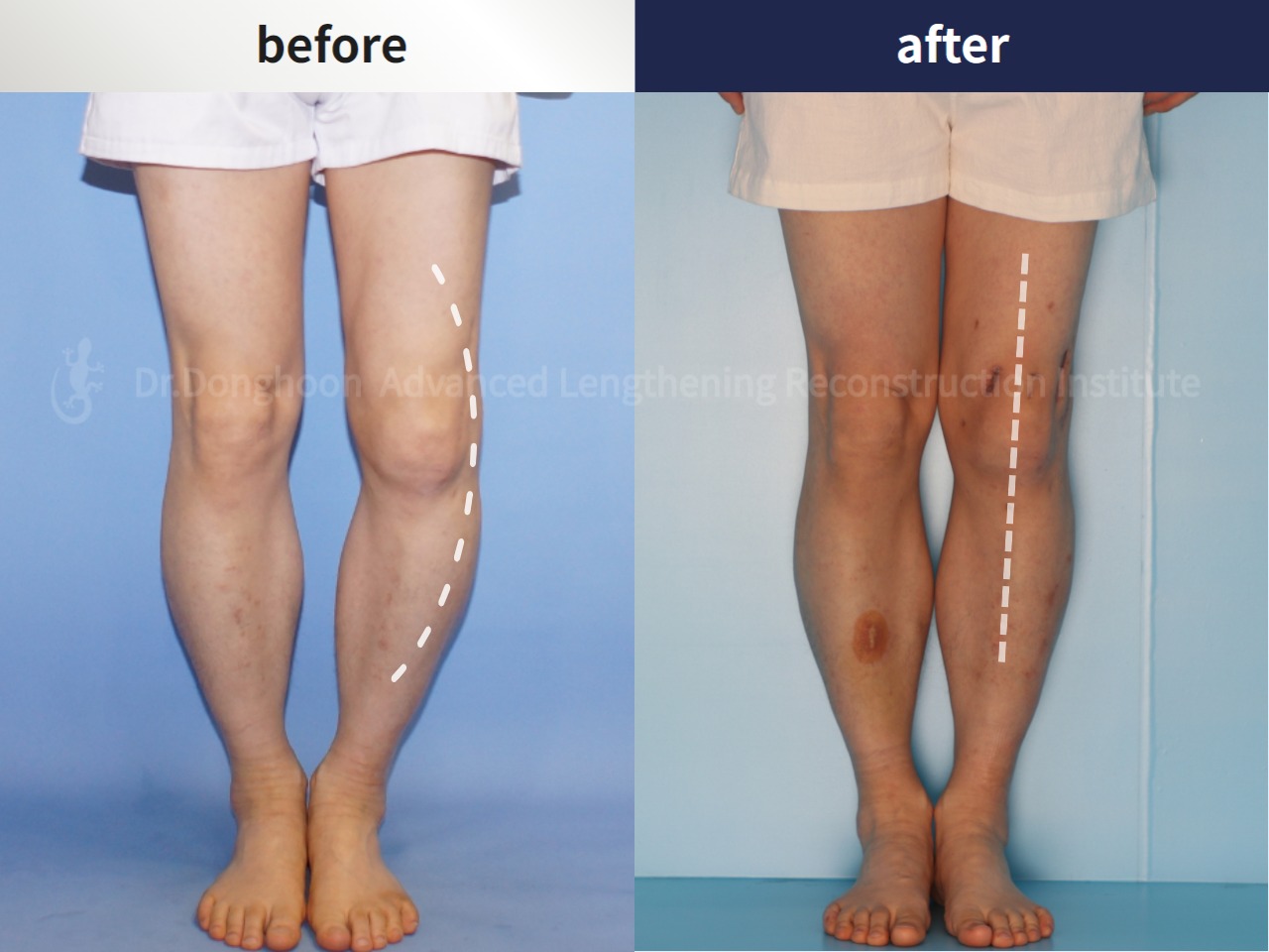 Before and after osteotomy for knee osteoarthritis, case 4306432, image 2, Dr. Donghoon institute (DALRI)
