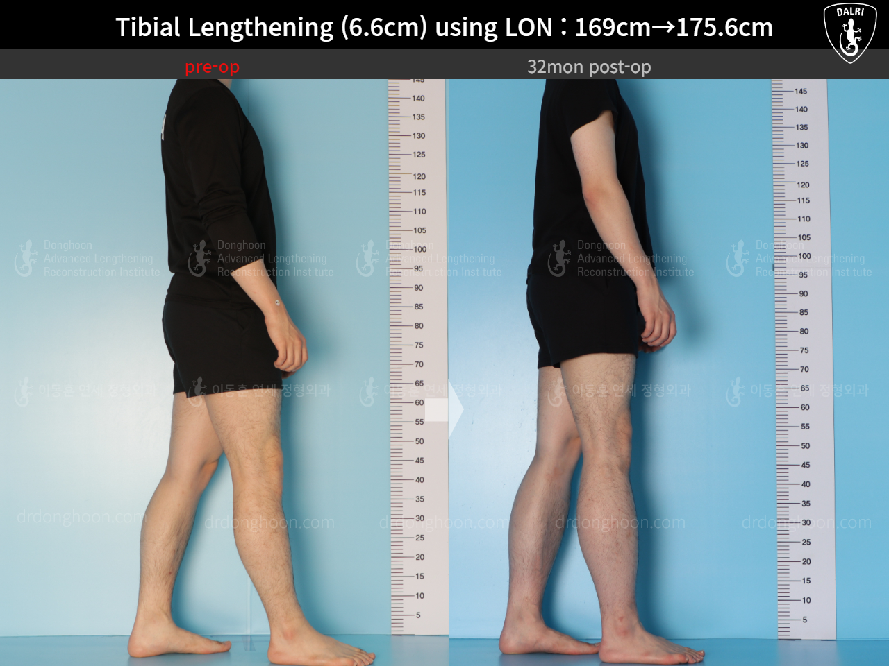 Before and after cll lon, case 15166302, image 7, Dr. Donghoon institute (DALRI)