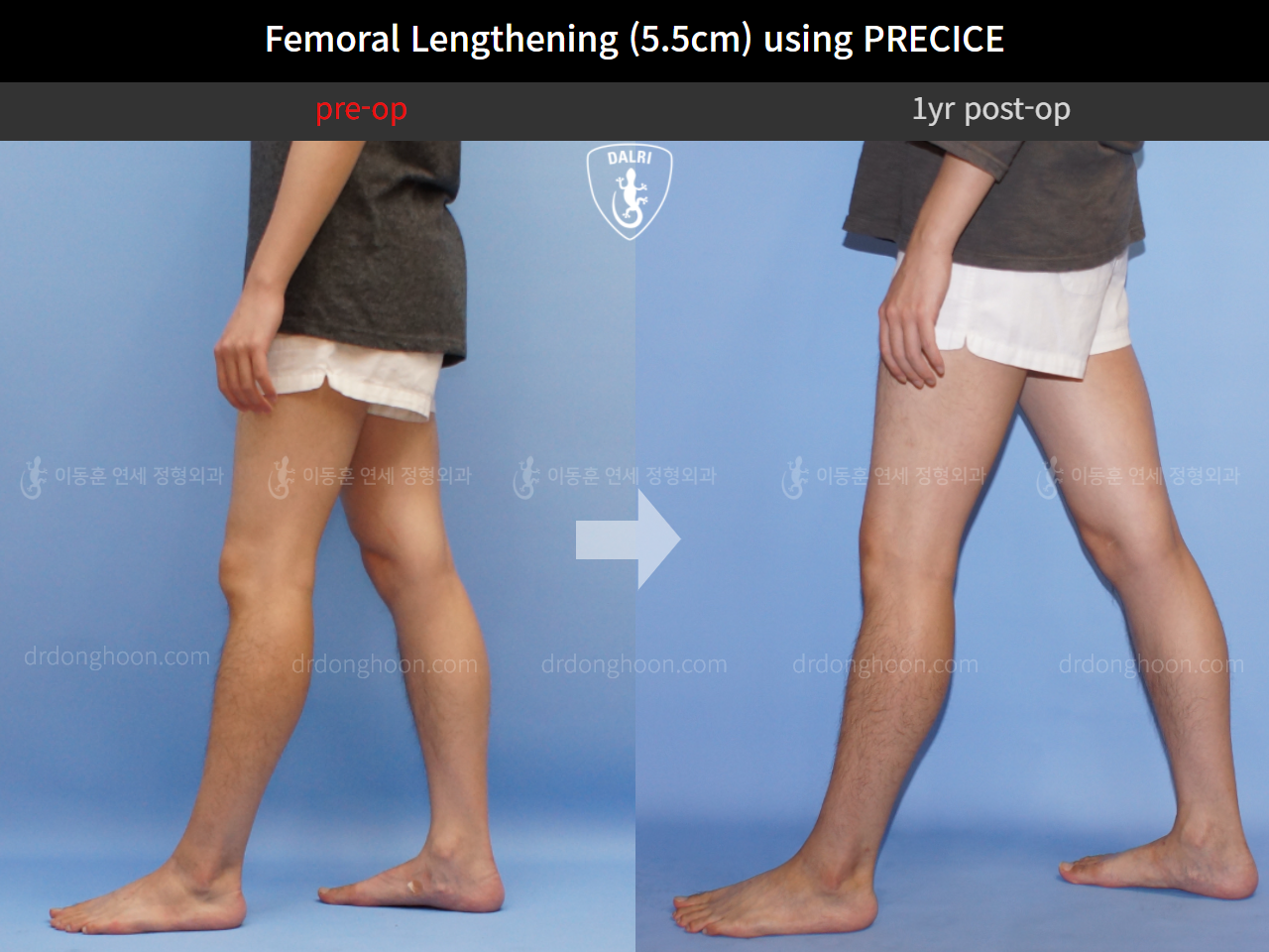Before and after cll precice, case 4323383, image 7, Dr. Donghoon institute (DALRI)
