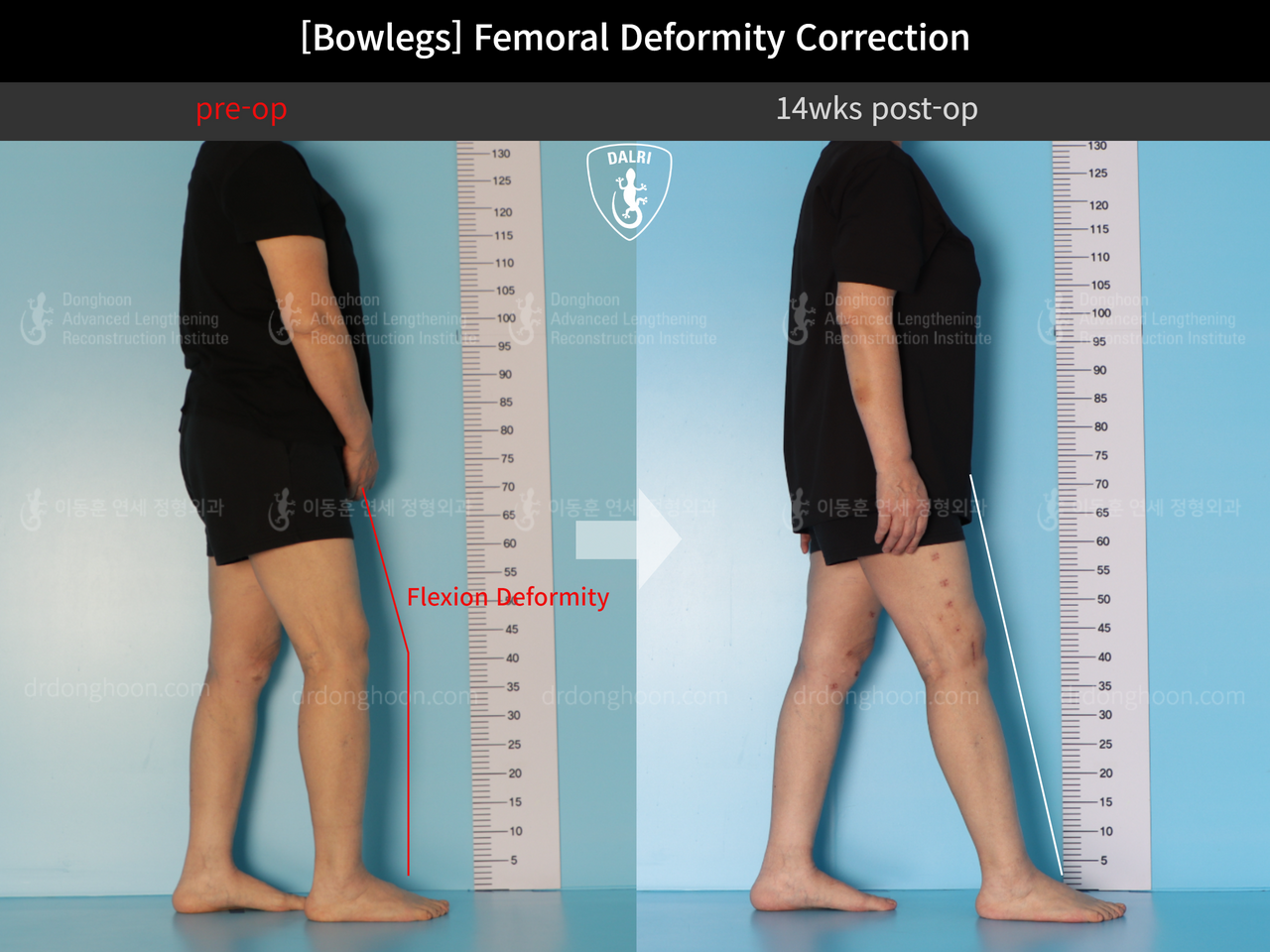 Before and after adult bowlegs, case 12791222, image 3, Dr. Donghoon institute (DALRI)