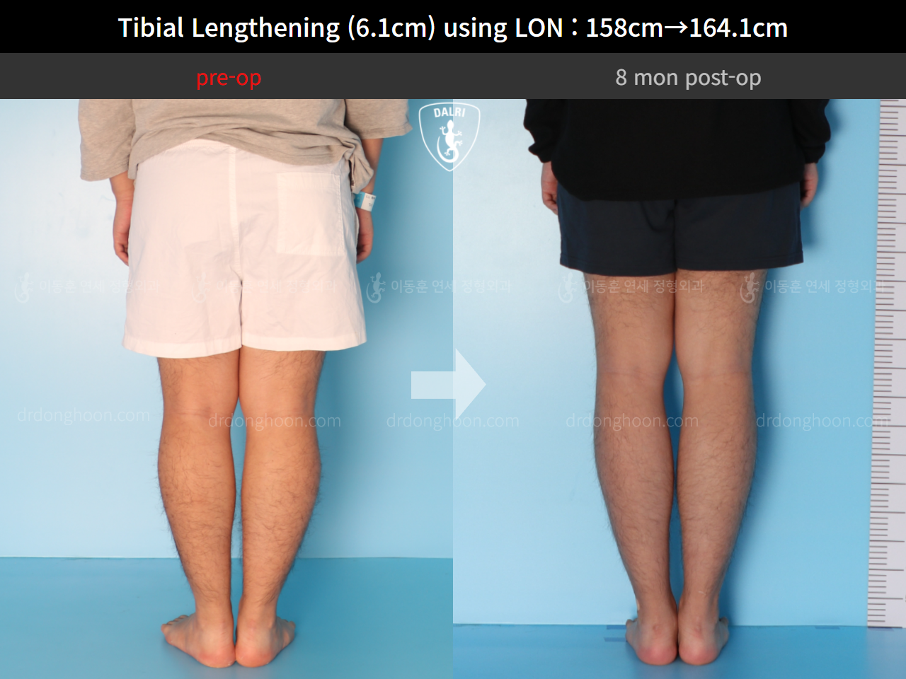 Before and after cll lon, case 4577743, image 6, Dr. Donghoon institute (DALRI)
