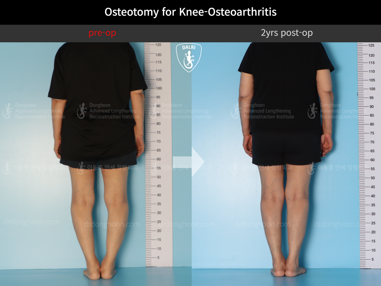 Before and after osteotomy for knee osteoarthritis, case 12844528, image 2, Dr. Donghoon institute (DALRI)