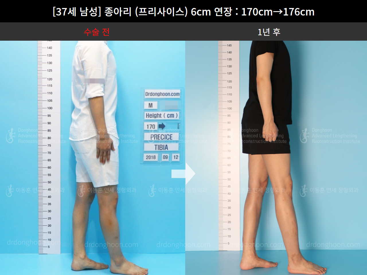 Before and after cll precice, case 4573549, image 3, Dr. Donghoon institute (DALRI)
