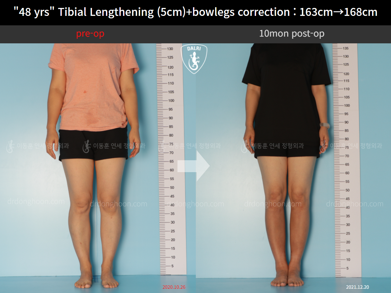 Before and after cll + deformity correction, case 10452764, image 1, Dr. Donghoon institute (DALRI)