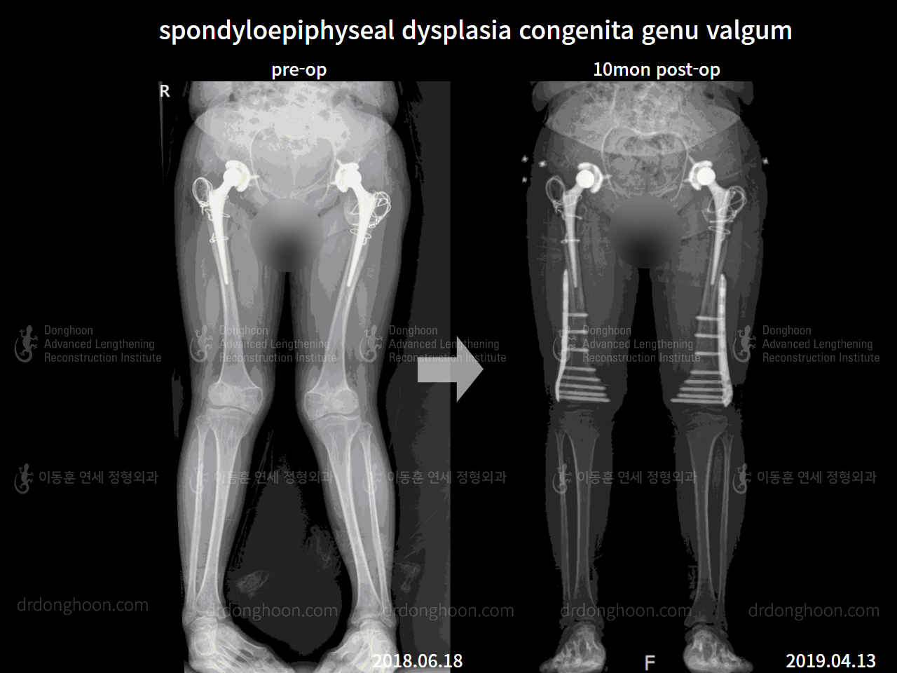 Before and after adult knock knees, case 8130481, image 3, Dr. Donghoon institute (DALRI)
