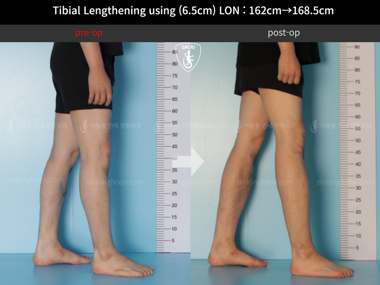 Before and after cll lon, case 11944171, image 7, Dr. Donghoon institute (DALRI)