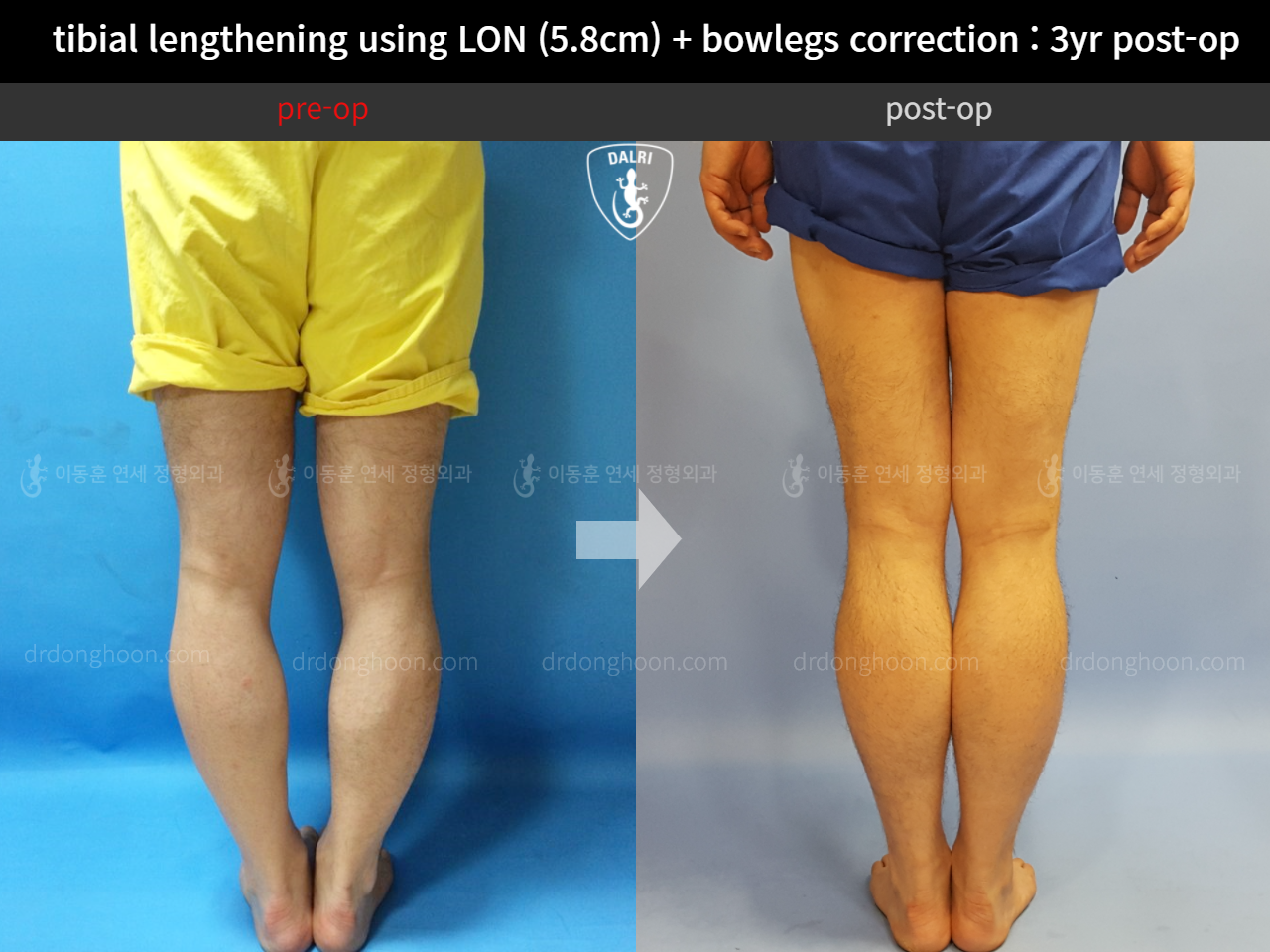 Before and after cll + deformity correction, case 11646008, image 3, Dr. Donghoon institute (DALRI)
