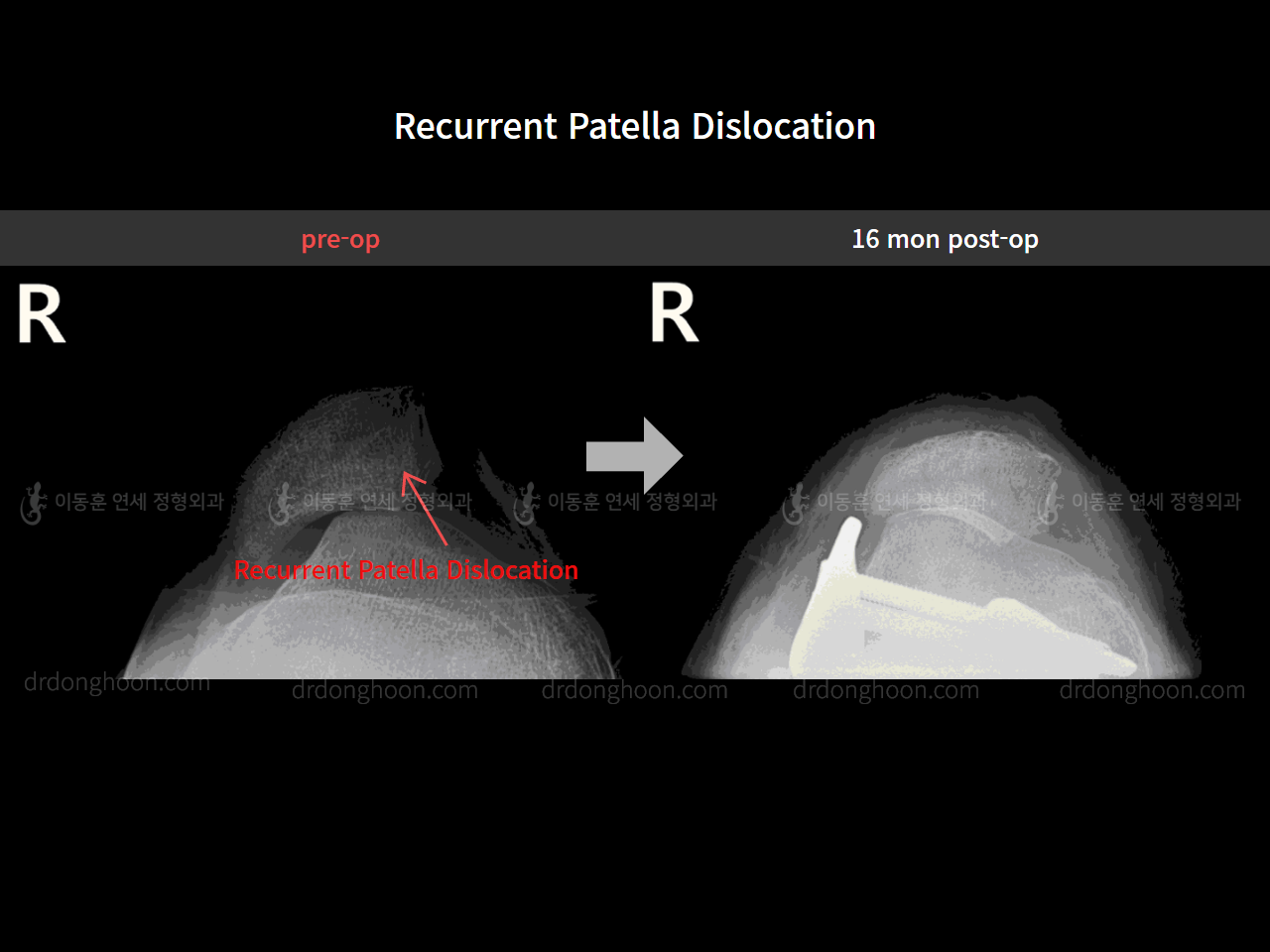 Before and after recurrent patella dislocation, case 8580605, image 7, Dr. Donghoon institute (DALRI)