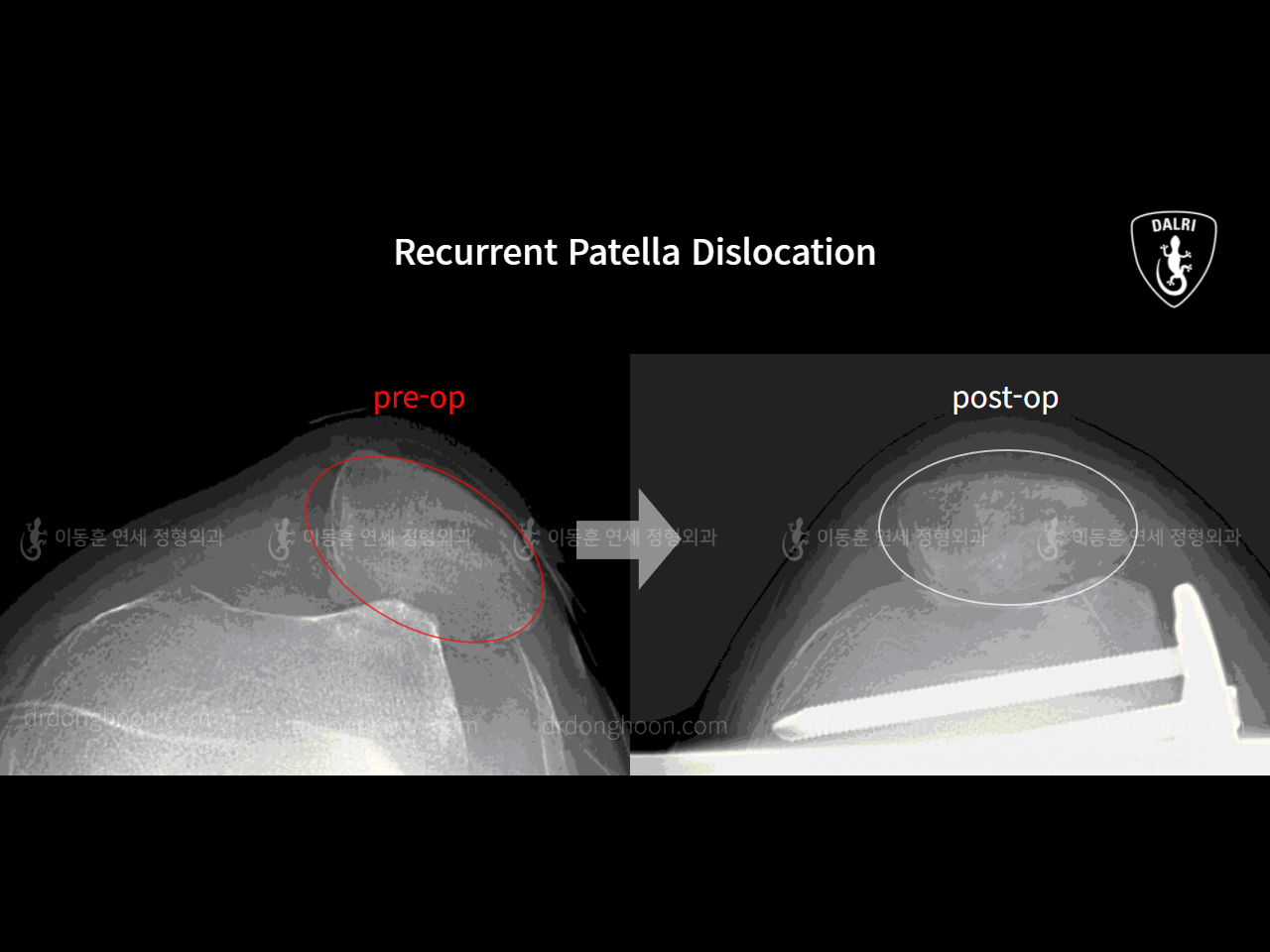 Before and after recurrent patella dislocation, case 10546870, image 6, Dr. Donghoon institute (DALRI)