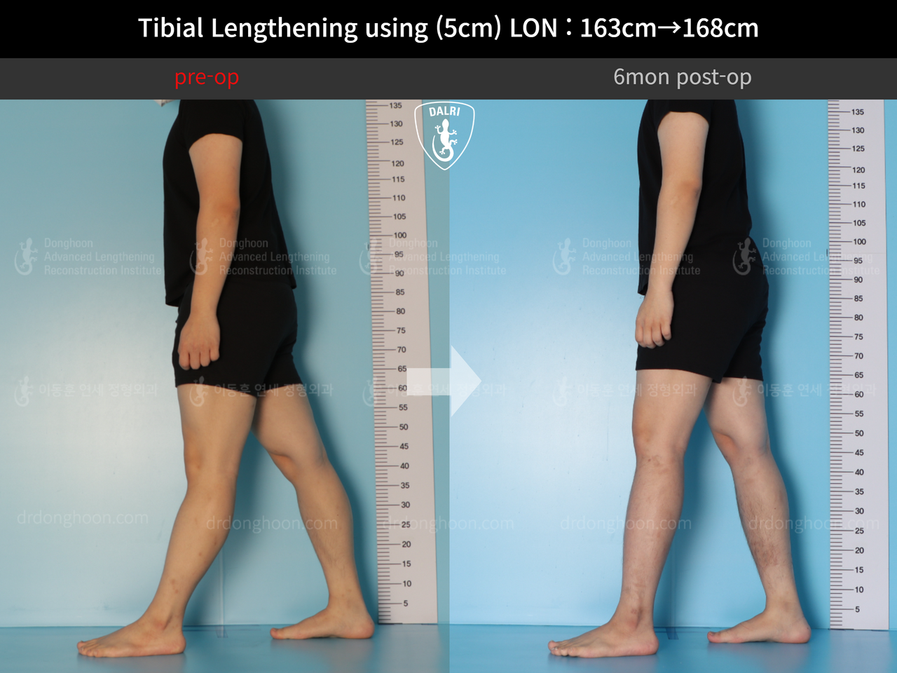 Before and after cll lon, case 12638628, image 3, Dr. Donghoon institute (DALRI)