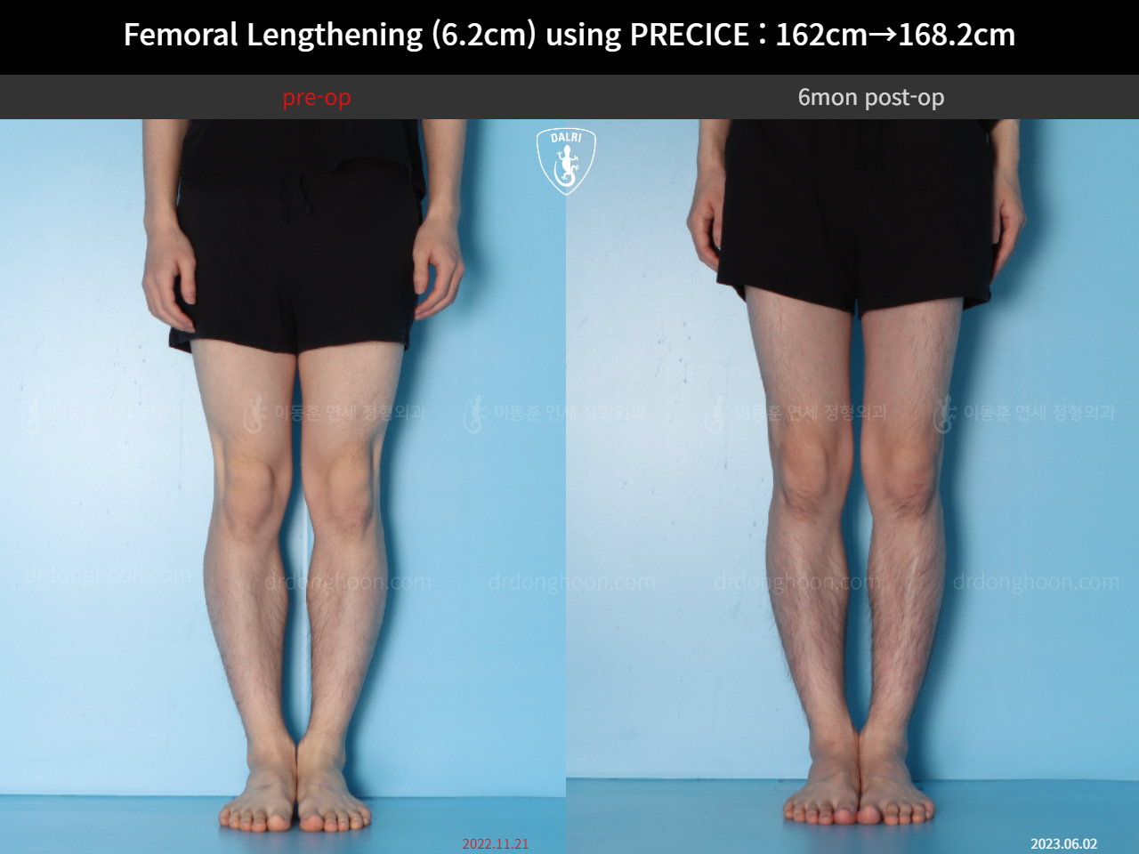 Before and after cll precice, case 15393865, image 9, Dr. Donghoon institute (DALRI)