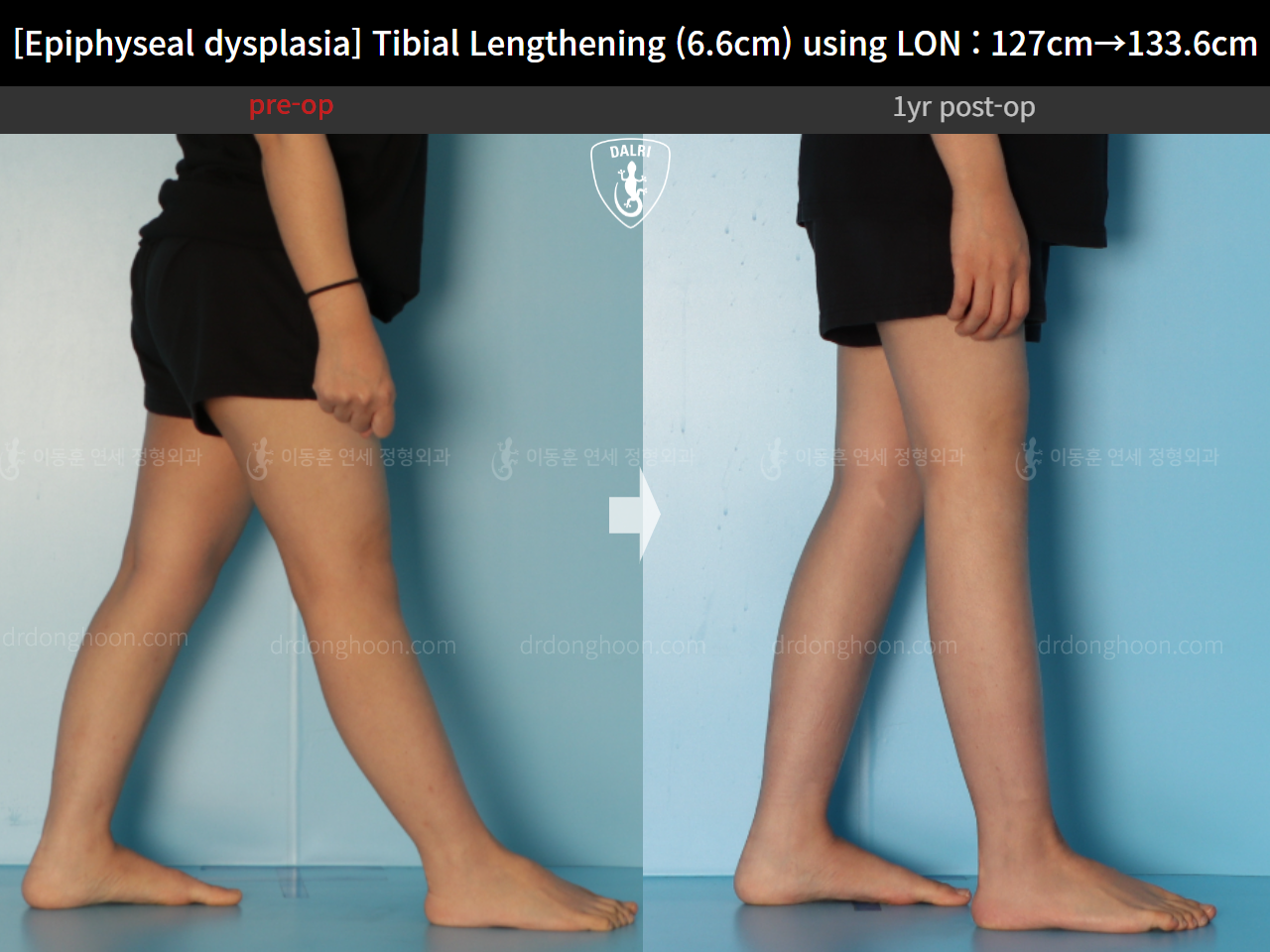 Before and after congenital condition, case 15072062, image 11, Dr. Donghoon institute (DALRI)