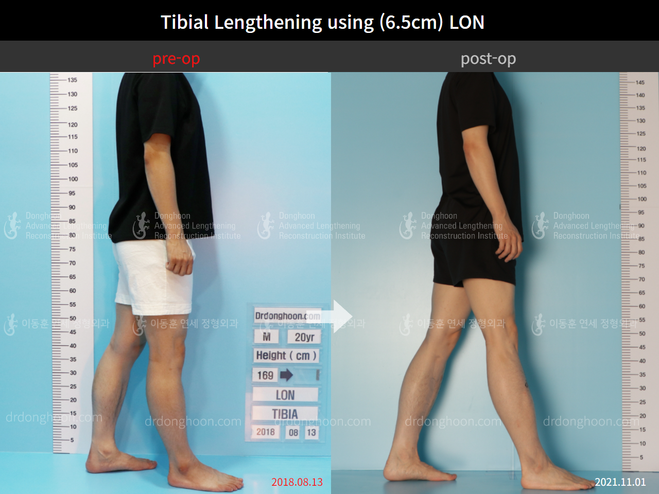 Before and after cll lon, case 8777040, image 3, Dr. Donghoon institute (DALRI)