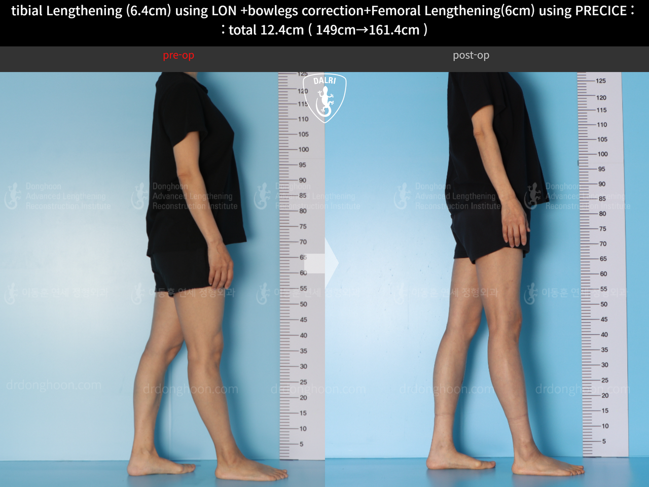 Before and after cll precice, case 13696246, image 7, Dr. Donghoon institute (DALRI)