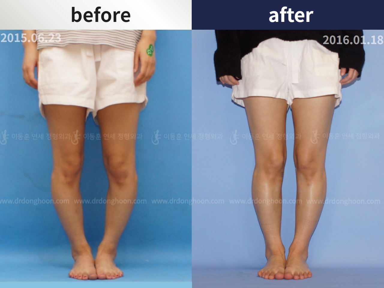 Before and after adult bowlegs, case 4311018, image 1, Dr. Donghoon institute (DALRI)