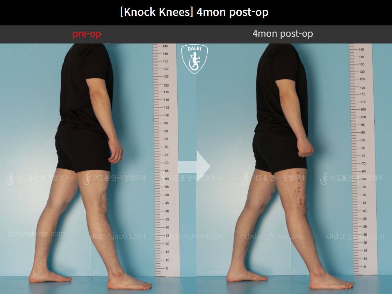 Before and after adult knock knees, case 10599771, image 4, Dr. Donghoon institute (DALRI)