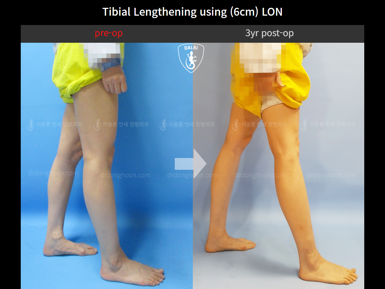 Before and after cll lon, case 4323981, image 7, Dr. Donghoon institute (DALRI)